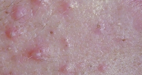 Acné