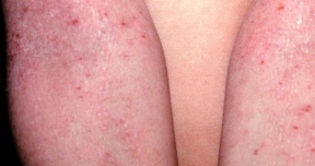 Dermatitis atópica