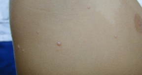 Moluscos contagiosos