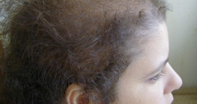 Pérdida de cabello