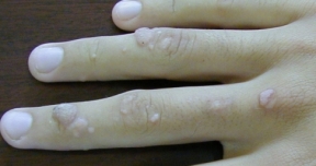 Verrugas